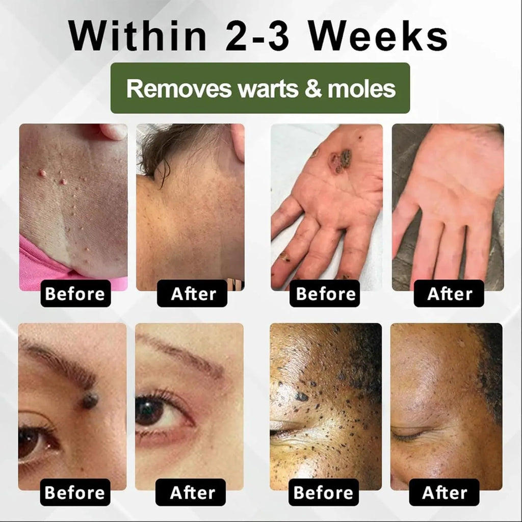 Natureerase Instant Mole Spot Removal Gel in 45g packaging with hydrating properties