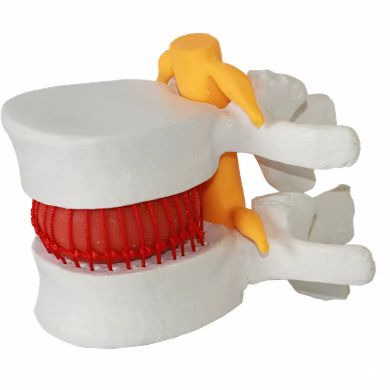 White PVC lumbar intervertebral disc herniation demonstration model for medical education