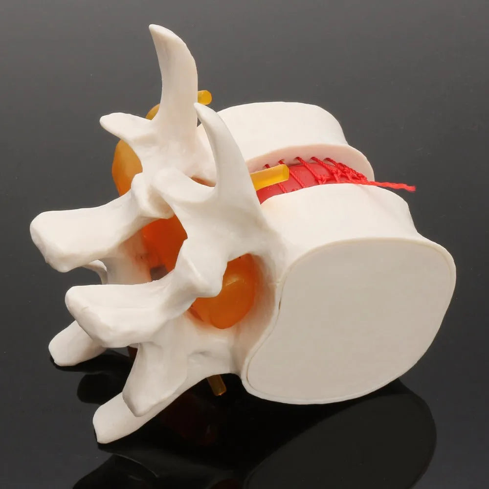 White PVC lumbar intervertebral disc herniation demonstration model for medical education