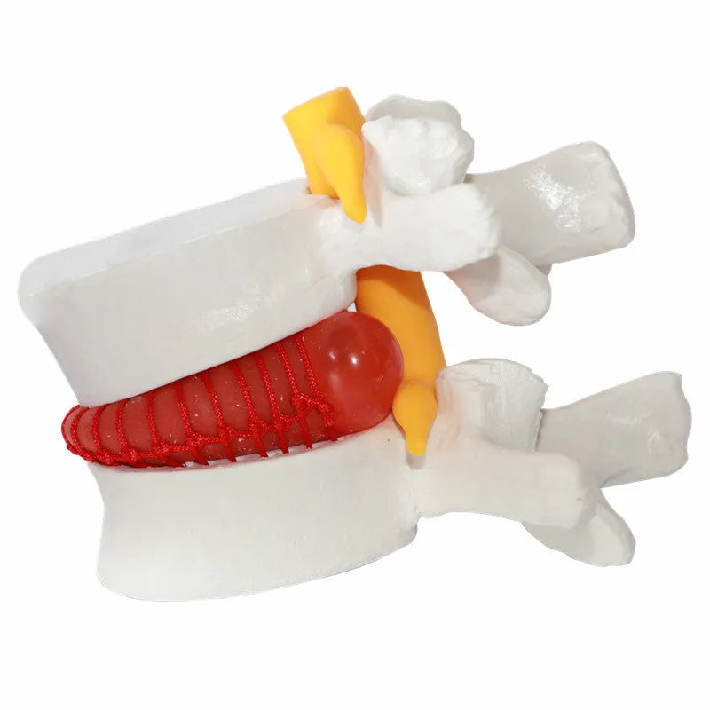 White PVC lumbar intervertebral disc herniation demonstration model for medical education
