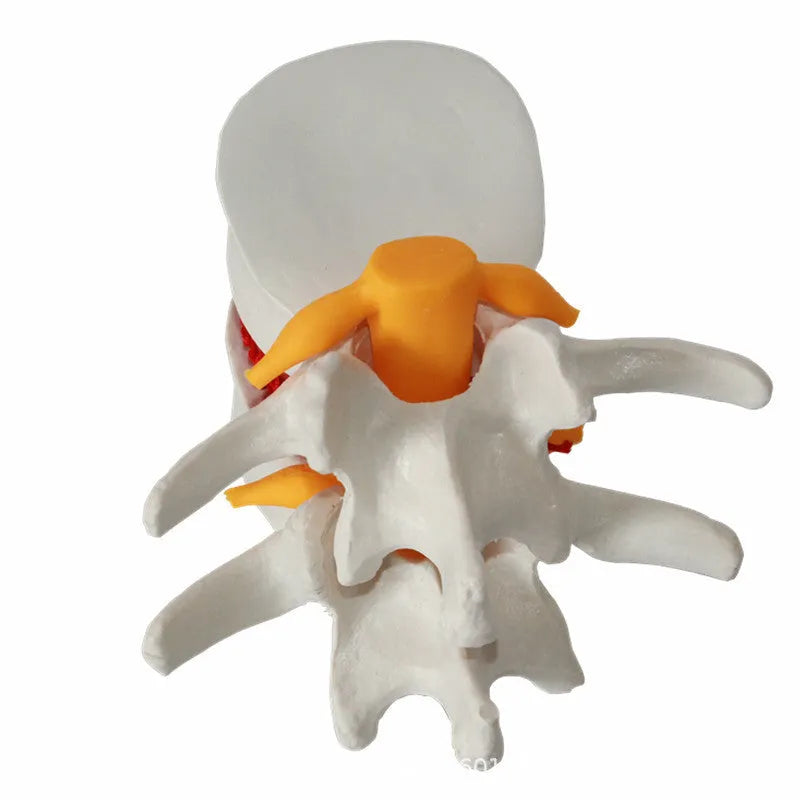 White PVC lumbar intervertebral disc herniation demonstration model for medical education