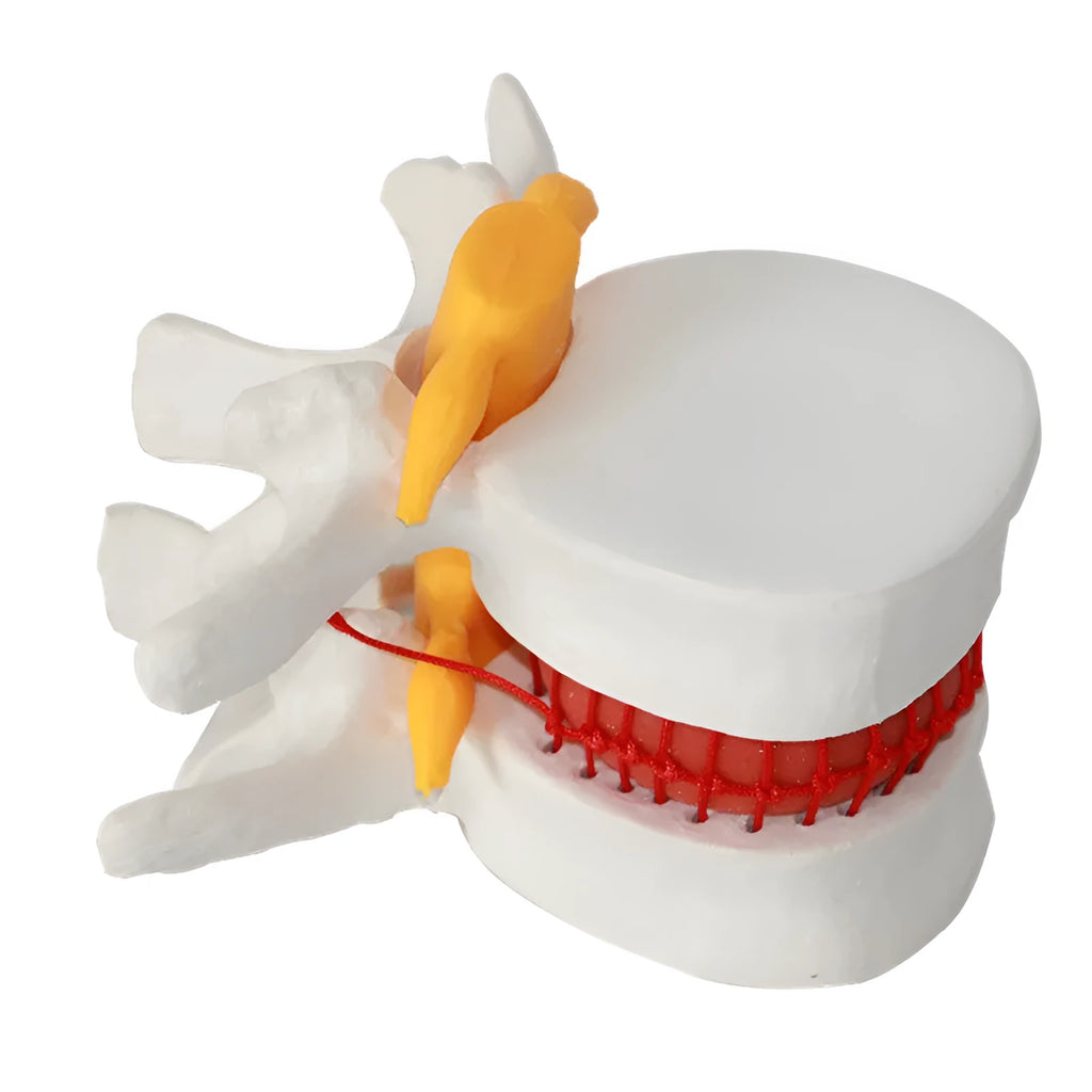 White PVC lumbar intervertebral disc herniation demonstration model for medical education