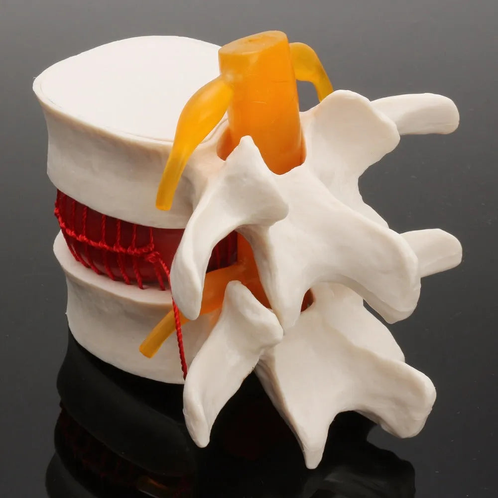 White PVC lumbar intervertebral disc herniation demonstration model for medical education
