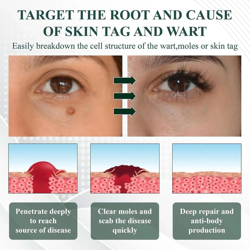 Natureerase Instant Mole Spot Removal Gel in 45g packaging with hydrating properties