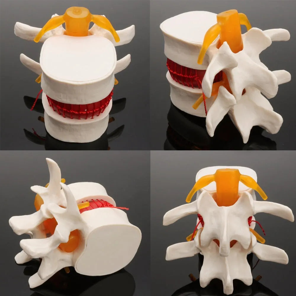 White PVC lumbar intervertebral disc herniation demonstration model for medical education